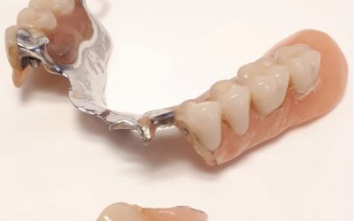 In Promozione riparazione protesi mobile e dentiera in 1 Ora a solo 75 euro